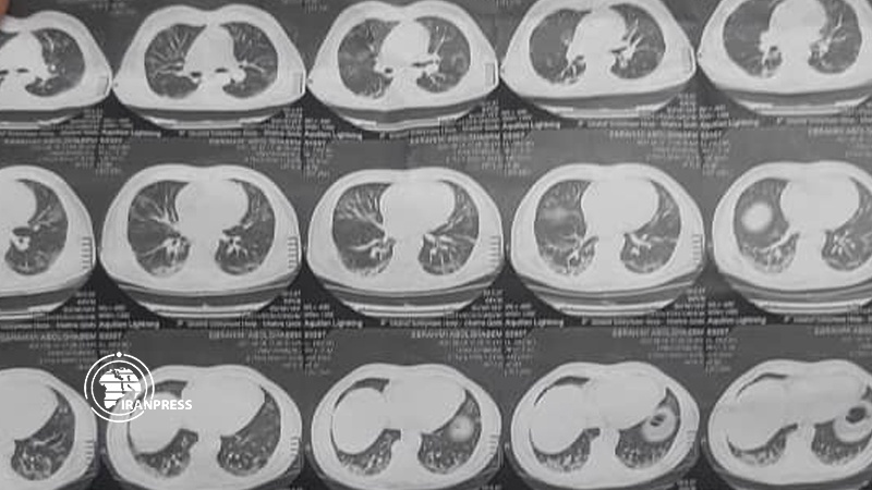 Iranpress: کشف طريقة مبتكرة لعلاج رئات المتعافين من كورونا